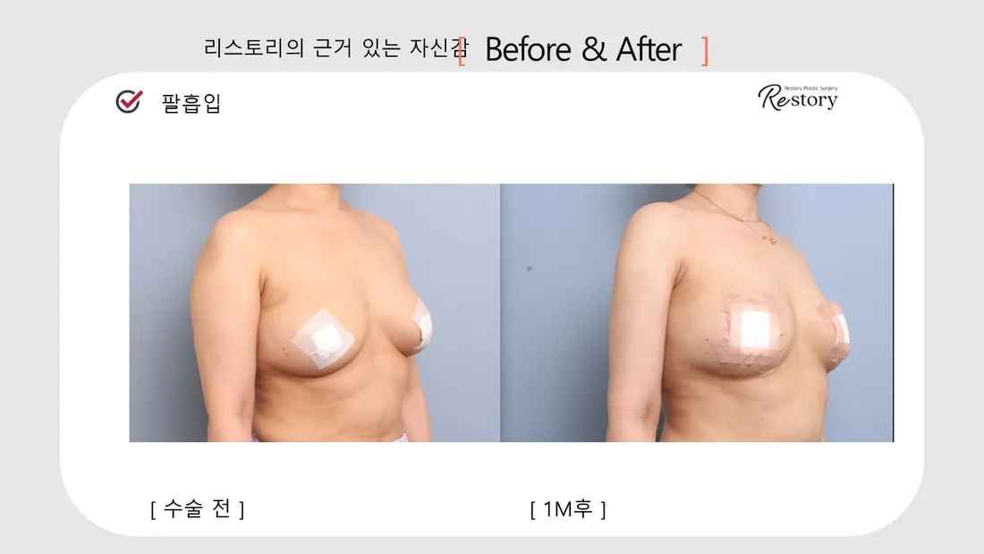美体瘦身 Before & After — Restory 整形外科