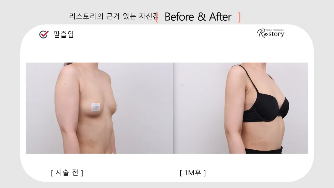美体瘦身 Before & After — Restory 整形外科