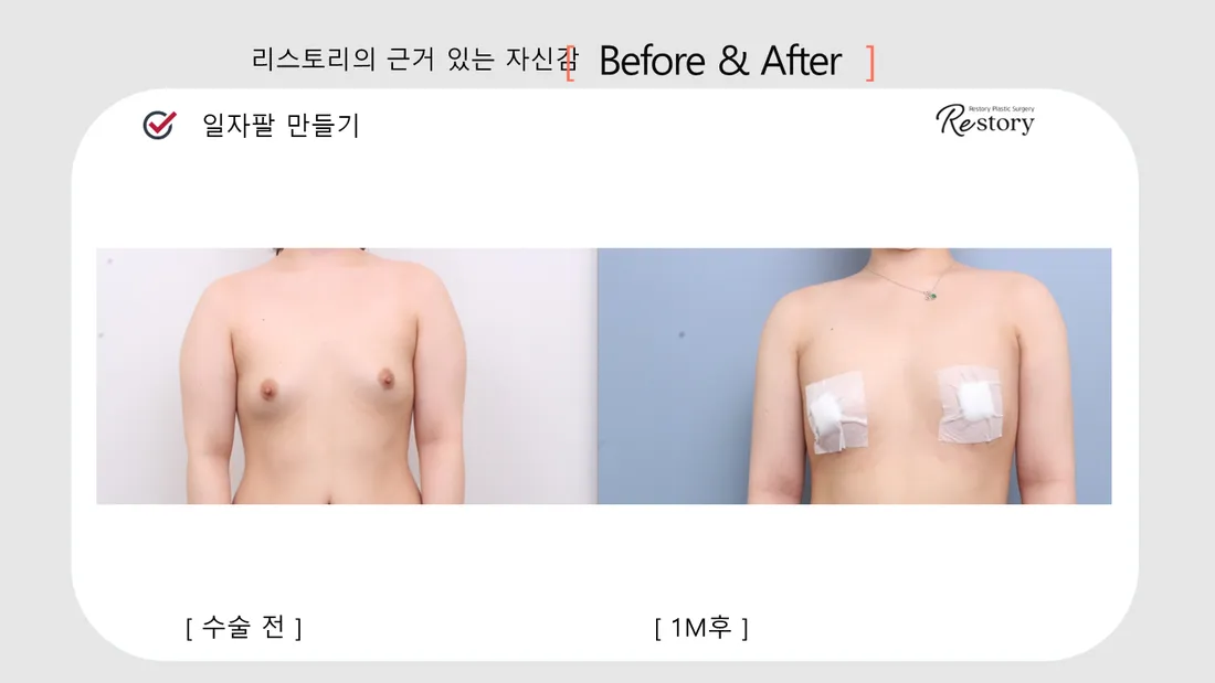 美体瘦身 Before & After — Restory 整形外科