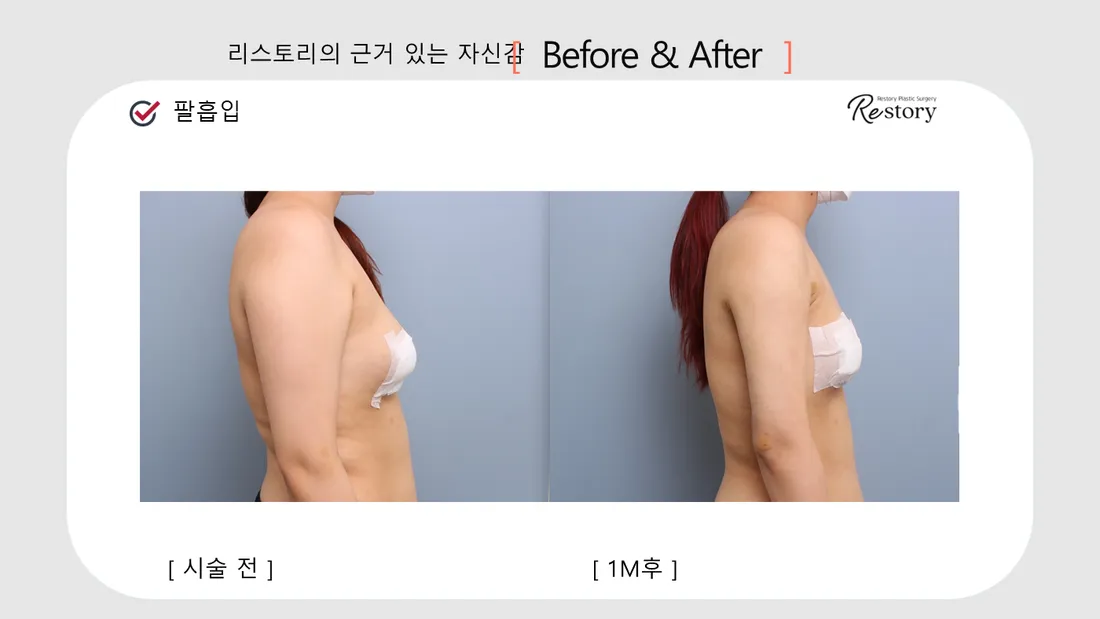 美体瘦身 Before & After — Restory 整形外科