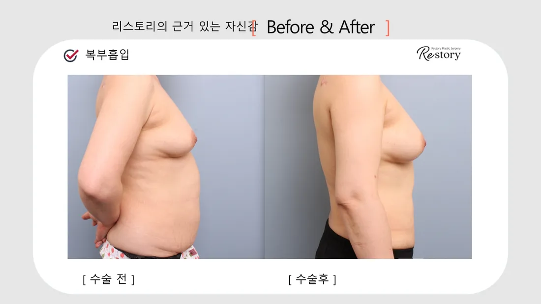 美体瘦身 Before & After — Restory 整形外科