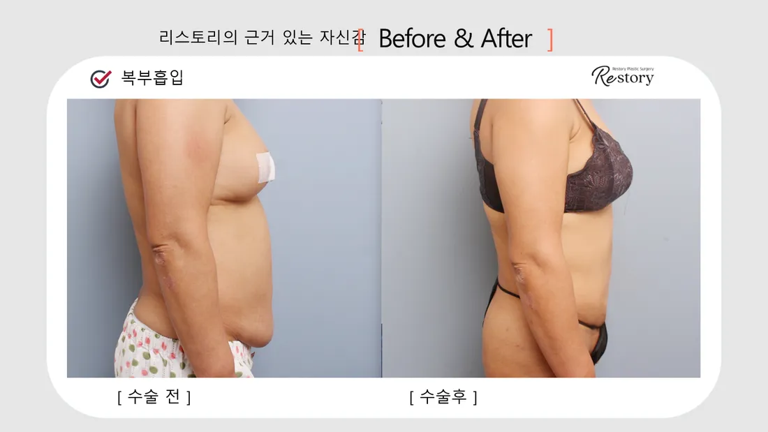 美体瘦身 Before & After — Restory 整形外科