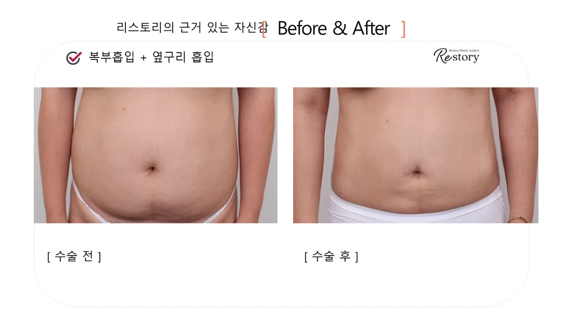 美体瘦身 Before & After — Restory 整形外科