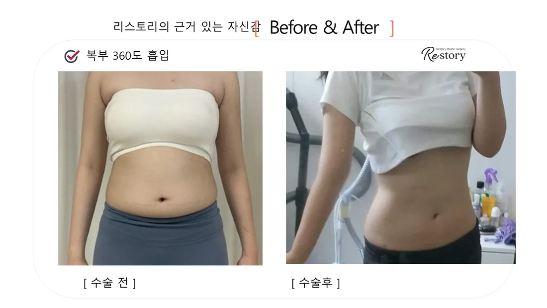 美体瘦身 Before & After — Restory 整形外科