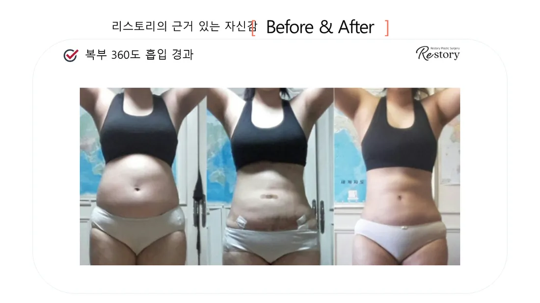 美体瘦身 Before & After — Restory 整形外科