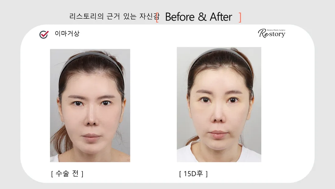 轮廓 Before & After — Restory 整形外科