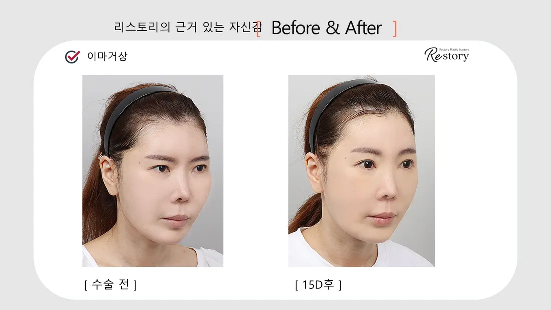 轮廓 Before & After — Restory 整形外科