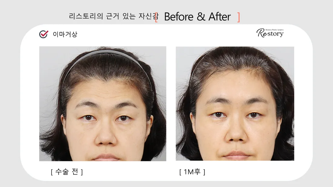 轮廓 Before & After — Restory 整形外科