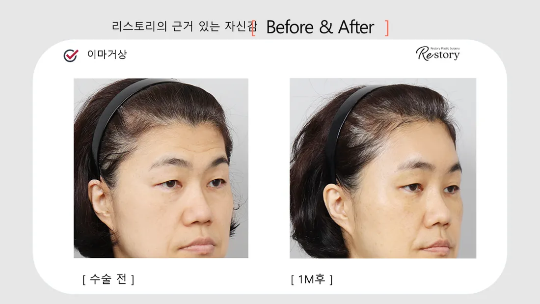 轮廓 Before & After — Restory 整形外科
