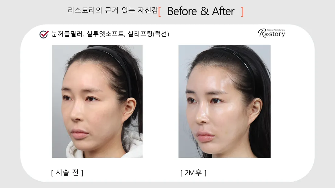 轮廓 Before & After — Restory 整形外科