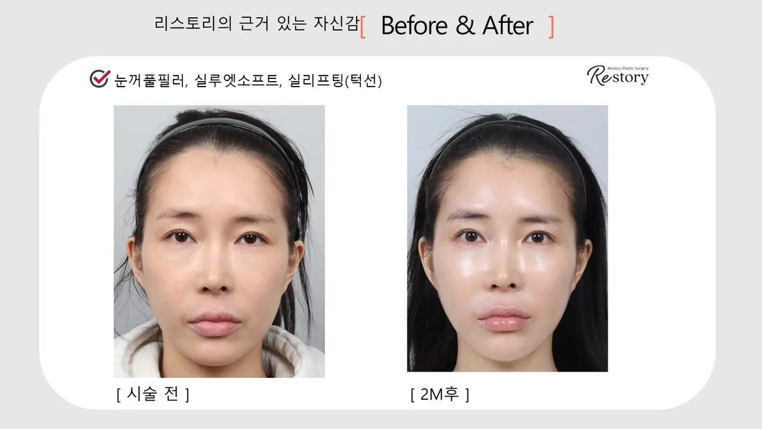 轮廓 Before & After — Restory 整形外科