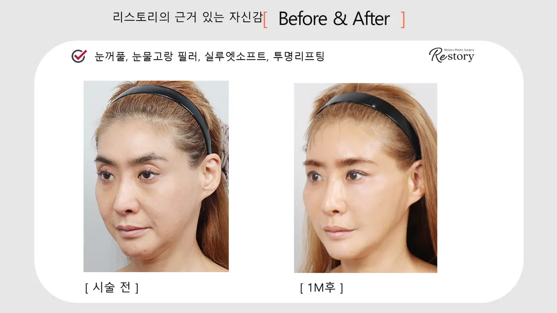 轮廓 Before & After — Restory 整形外科
