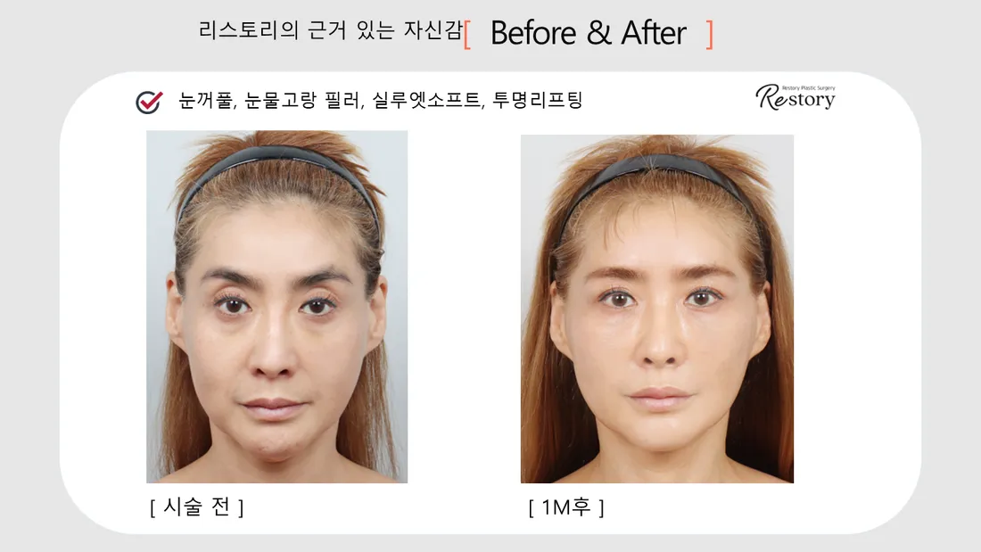 轮廓 Before & After — Restory 整形外科