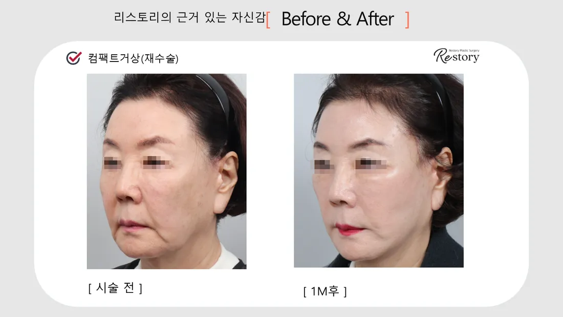 轮廓 Before & After — Restory 整形外科