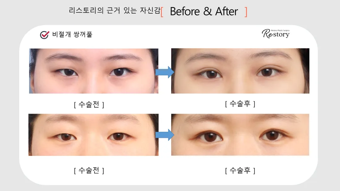 眼部 Before & After — Restory 整形外科