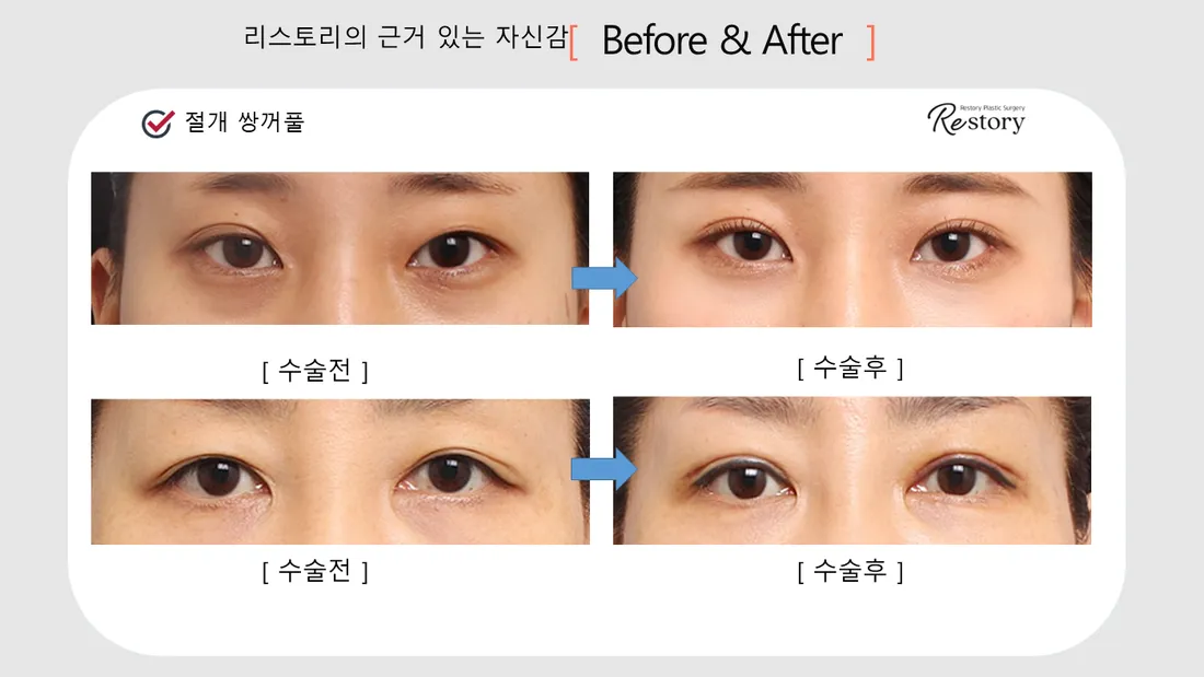 眼部 Before & After — Restory 整形外科