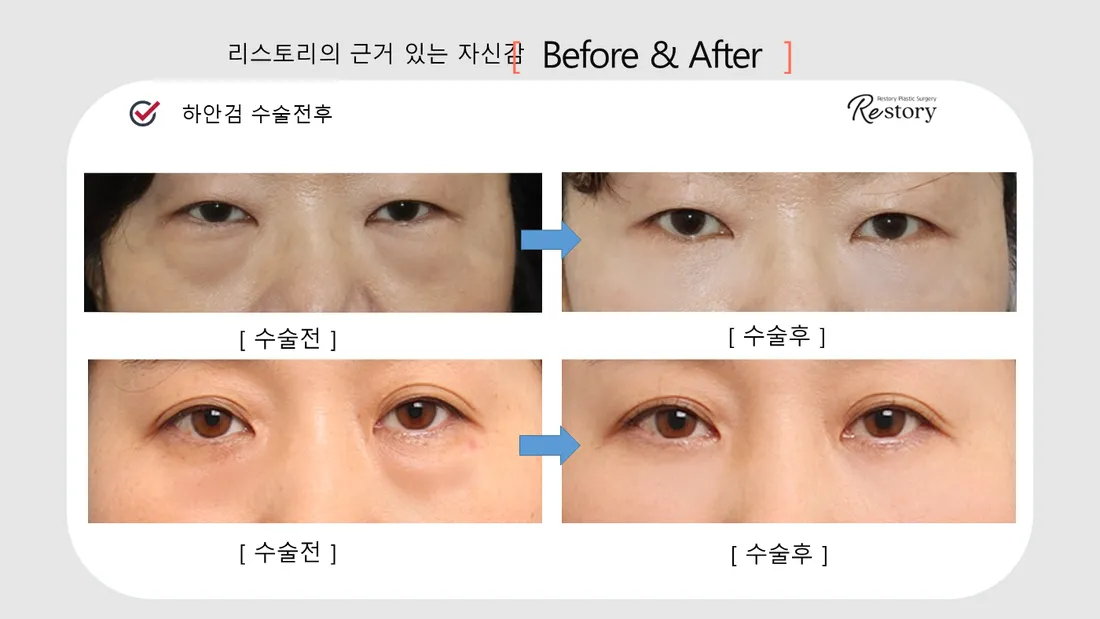 眼部 Before & After — Restory 整形外科