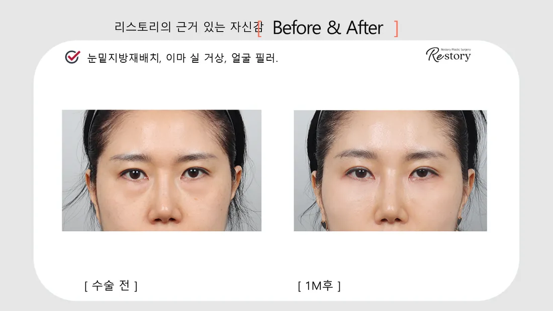 眼部 Before & After — Restory 整形外科