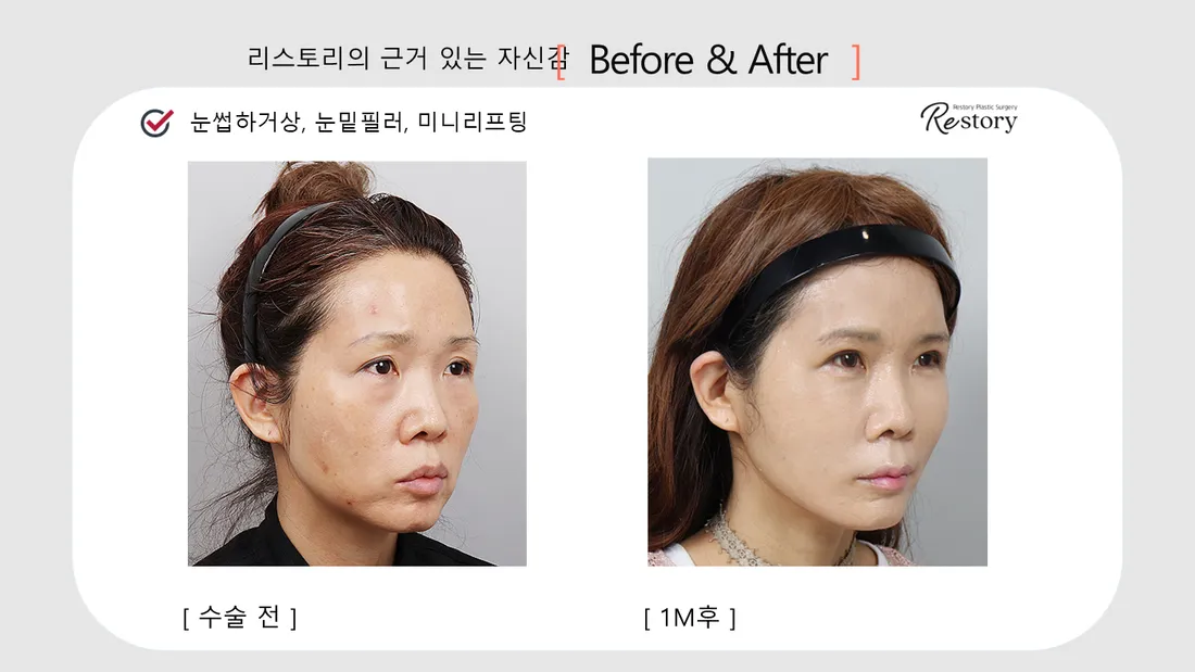 眼部 Before & After — Restory 整形外科
