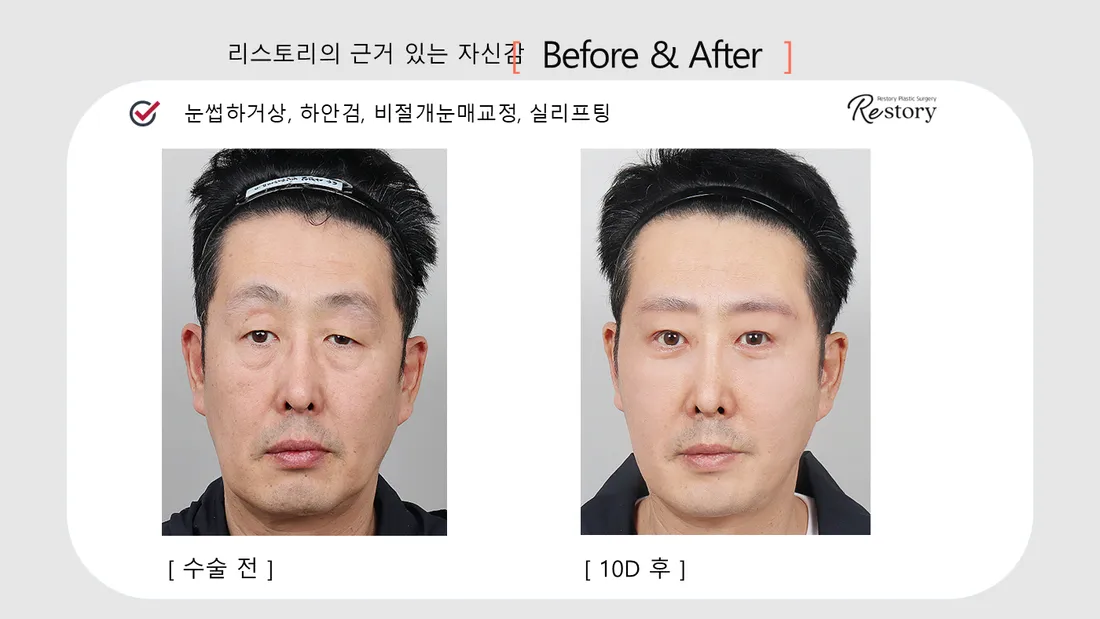 眼部 Before & After — Restory 整形外科