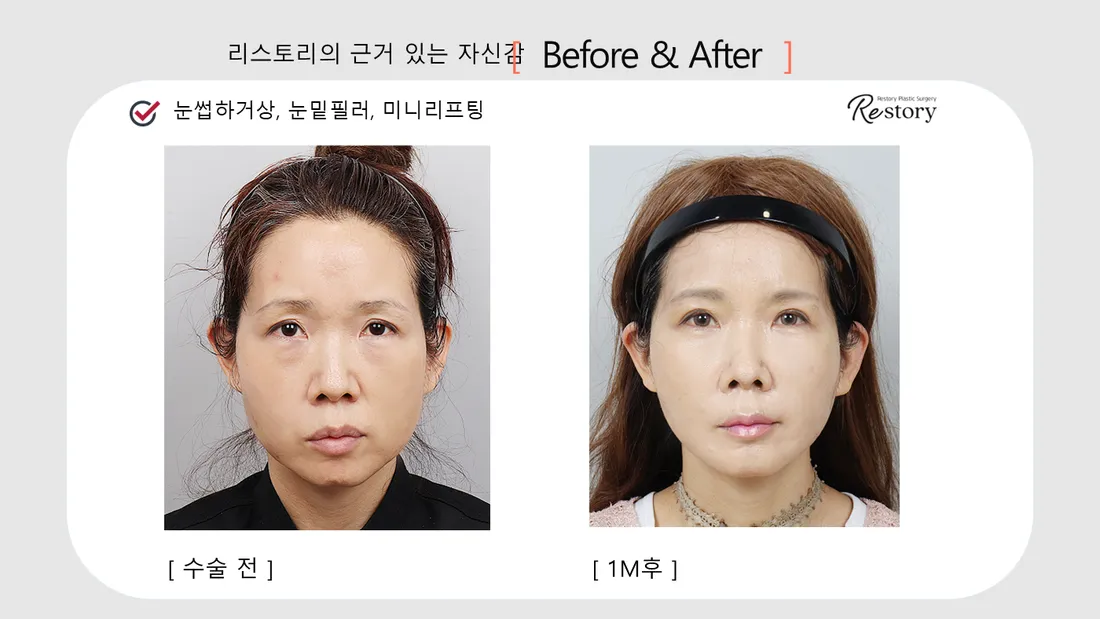眼部 Before & After — Restory 整形外科
