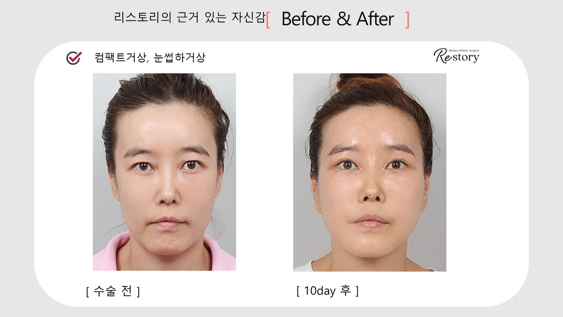 眼部 Before & After — Restory 整形外科