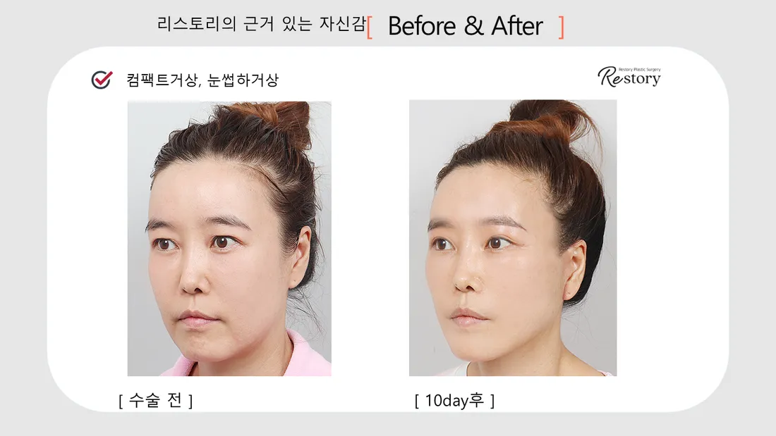 眼部 Before & After — Restory 整形外科