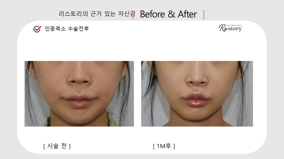 下颌线·嘴唇·牙科 Before & After — Restory 整形外科