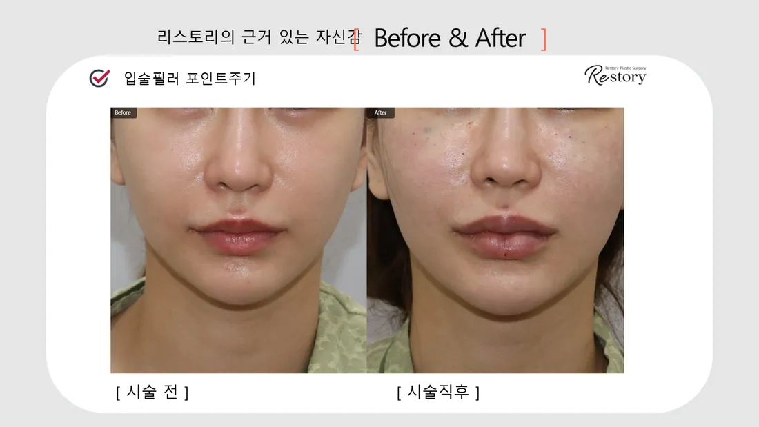 下颌线·嘴唇·牙科 Before & After — Restory 整形外科