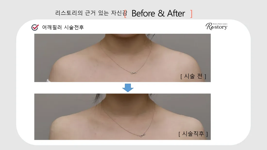 颈部·肩部 Before & After — Restory 整形外科