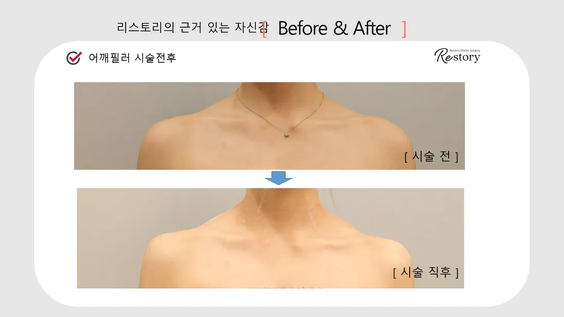 颈部·肩部 Before & After — Restory 整形外科
