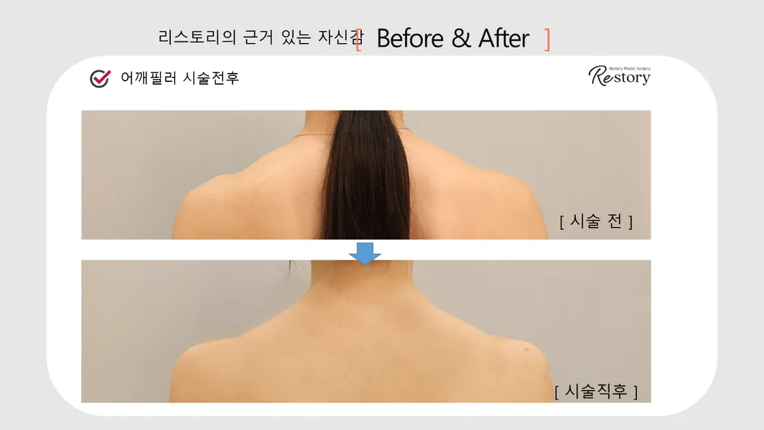 颈部·肩部 Before & After — Restory 整形外科