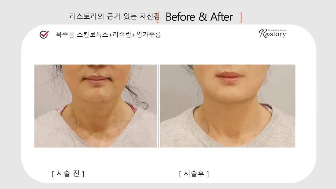 颈部·肩部 Before & After — Restory 整形外科