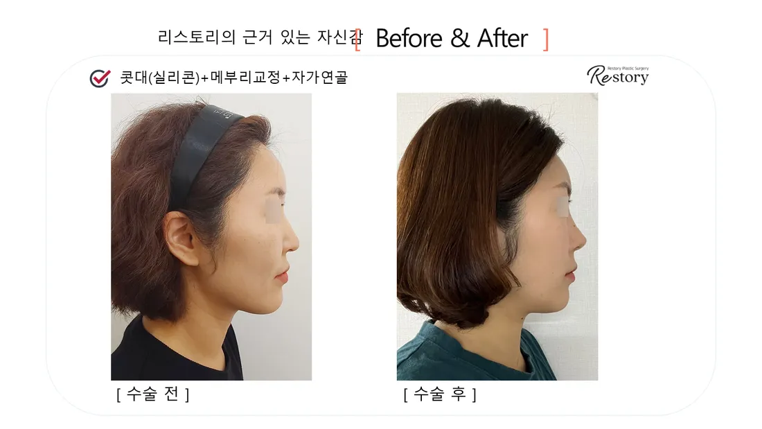 鼻部 Before & After — Restory 整形外科