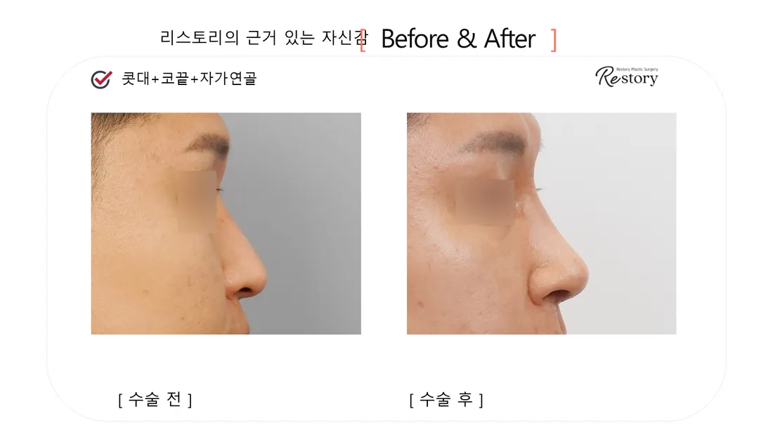 鼻部 Before & After — Restory 整形外科