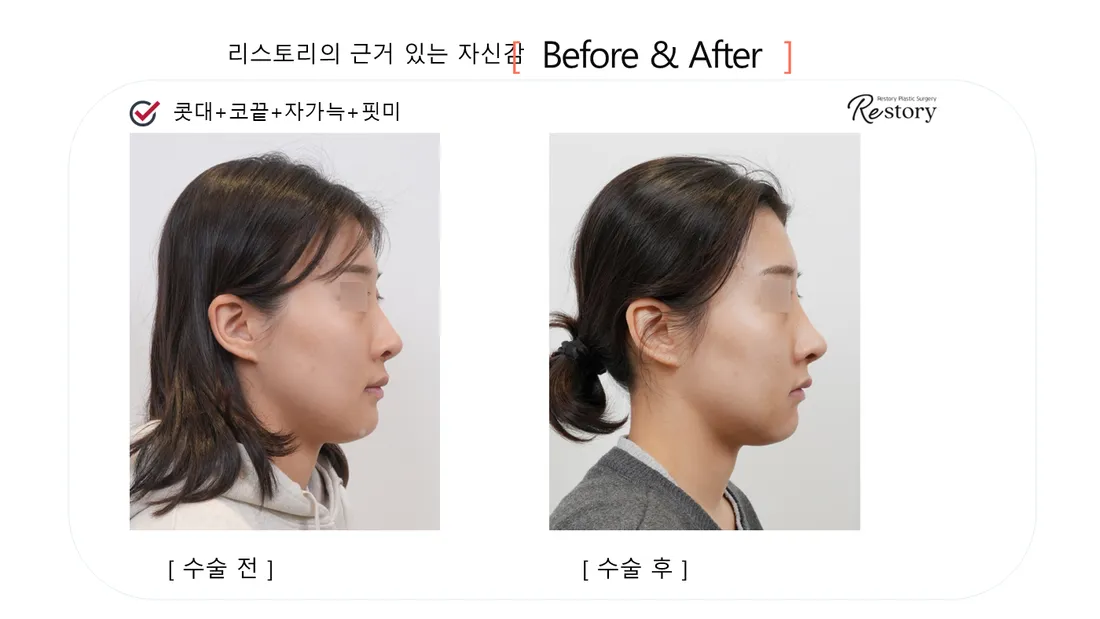 鼻部 Before & After — Restory 整形外科