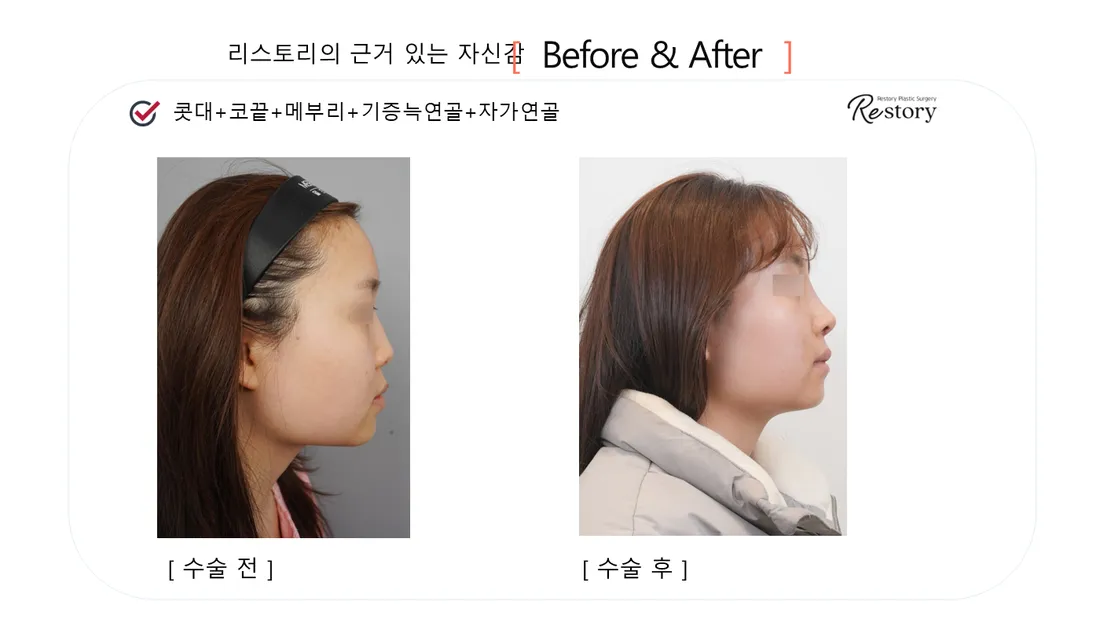 鼻部 Before & After — Restory 整形外科