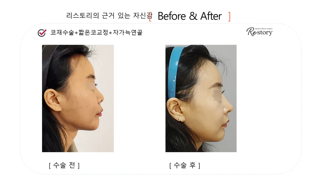 鼻部 Before & After — Restory 整形外科