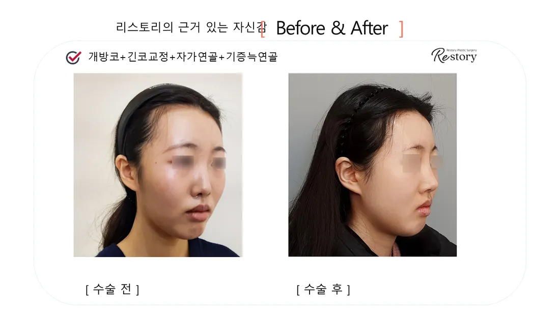 鼻部 Before & After — Restory 整形外科