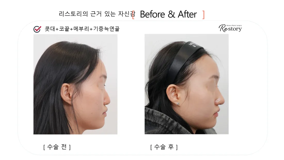 鼻部 Before & After — Restory 整形外科