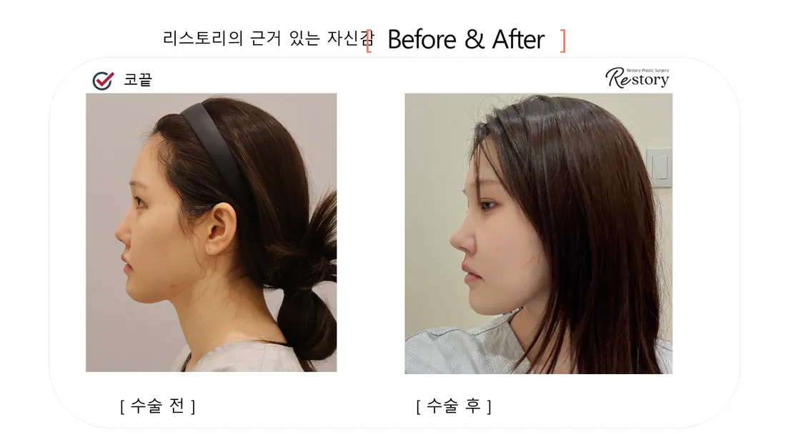 鼻部 Before & After — Restory 整形外科