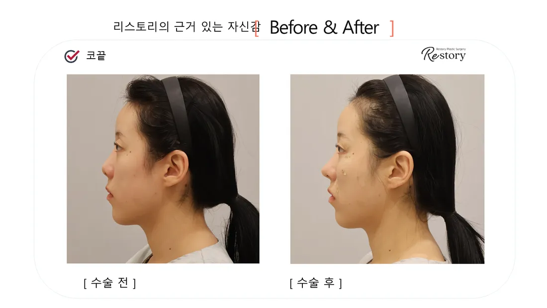 鼻部 Before & After — Restory 整形外科