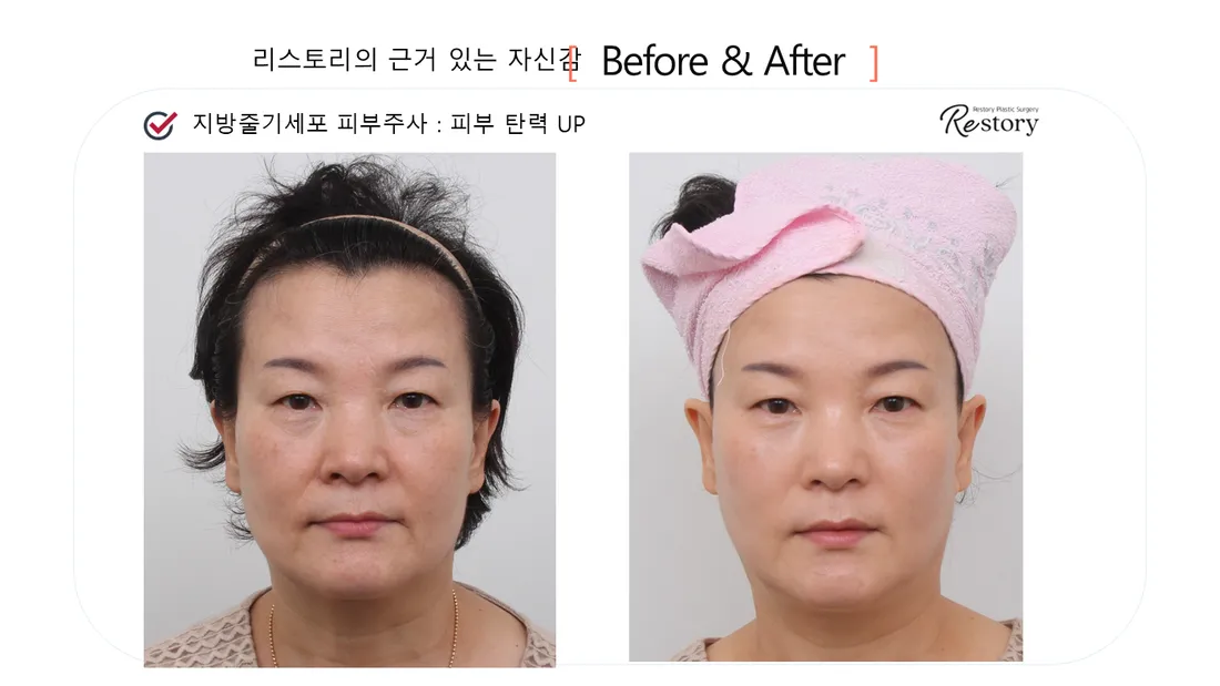 皮肤管理 Before & After — Restory 整形外科
