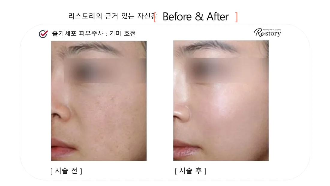 皮肤管理 Before & After — Restory 整形外科