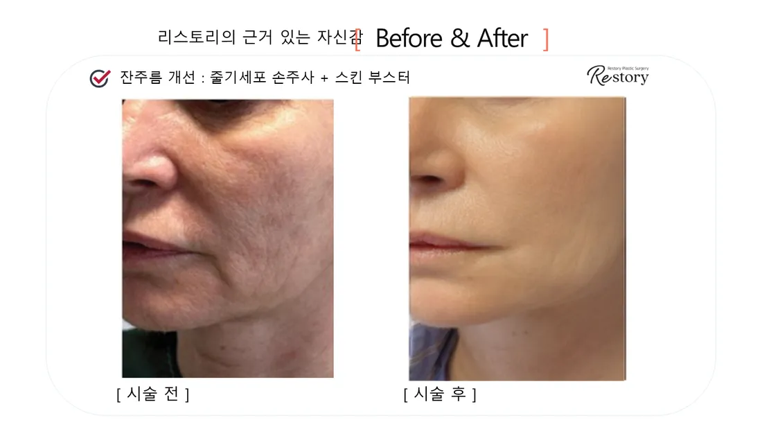 皮肤管理 Before & After — Restory 整形外科