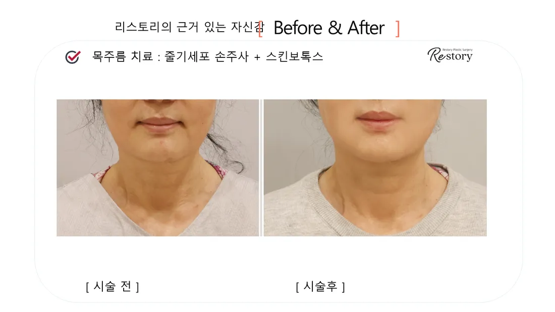 皮肤管理 Before & After — Restory 整形外科