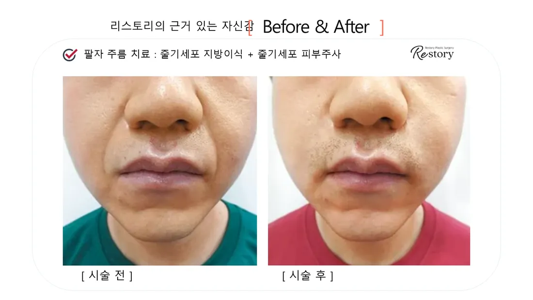 皮肤管理 Before & After — Restory 整形外科