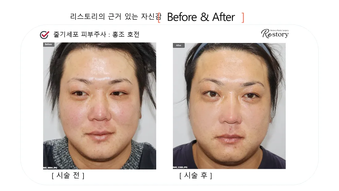 皮肤管理 Before & After — Restory 整形外科