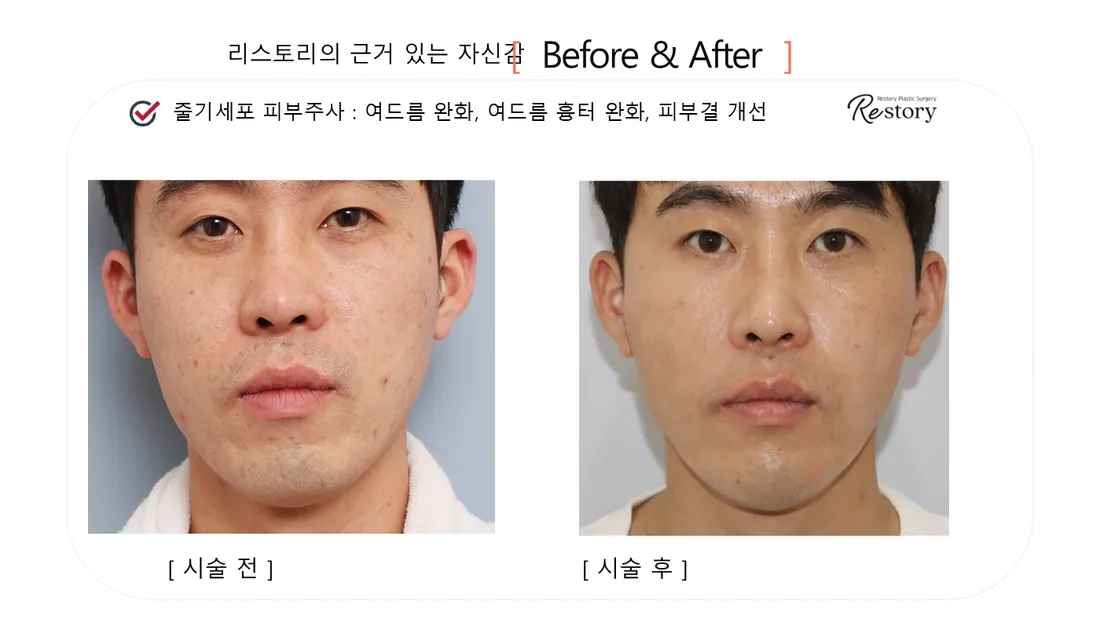 皮肤管理 Before & After — Restory 整形外科
