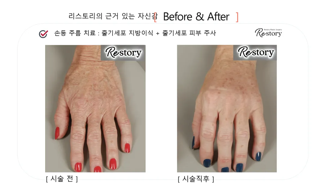 皮肤管理 Before & After — Restory 整形外科